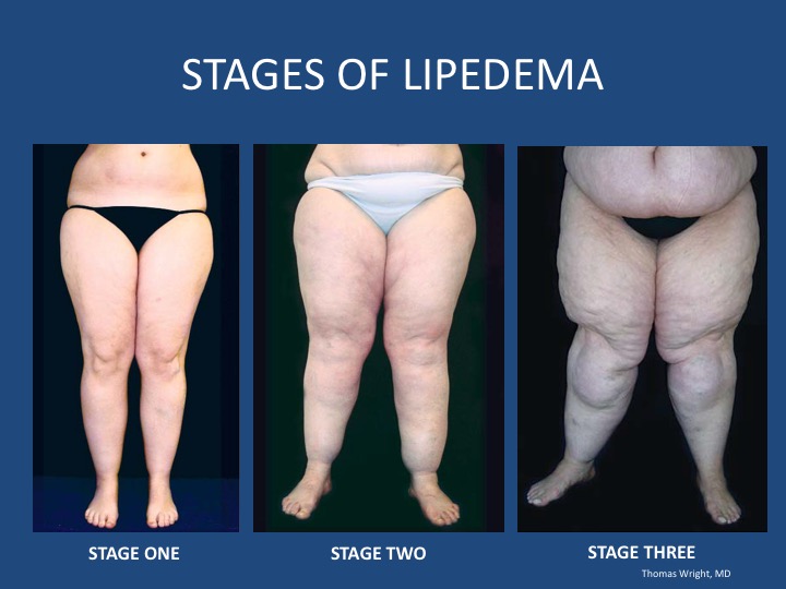 Lipedema Roma